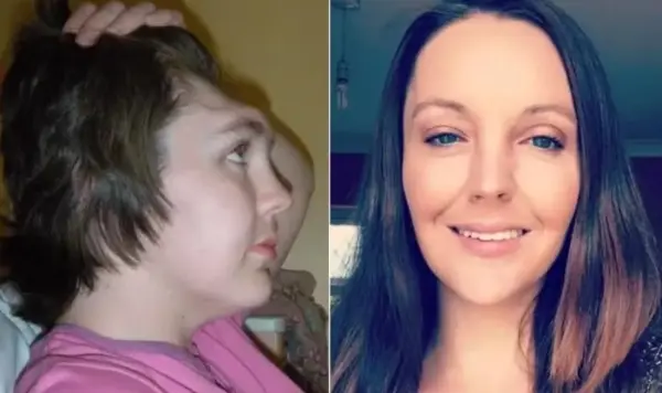 Mulher que perdeu a testa após grave acidente de carro faz alerta ao presenciar o mesmo erro que cometeu 1 Mulher que perdeu a testa após grave acidente de carro faz alerta ao presenciar o mesmo erro que cometeu