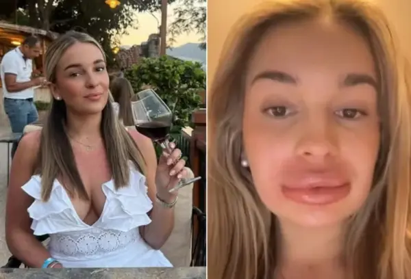 Mulher tem forte reação a preenchimento labial, e esteticista culpa 'menstruação'
