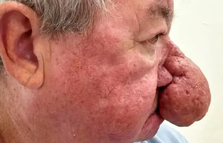 Gerard McAliece sofria de rinofima, quadro que o deixou com nariz gigantesco, cobrindo até a boca — Foto: Reprodução/Ever Clinic
