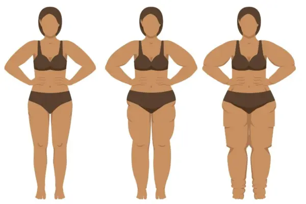 Lipedema: médico revela alimentos que ajudam no tratamento da doença 1 Lipedema: médico revela alimentos que ajudam no tratamento da doença