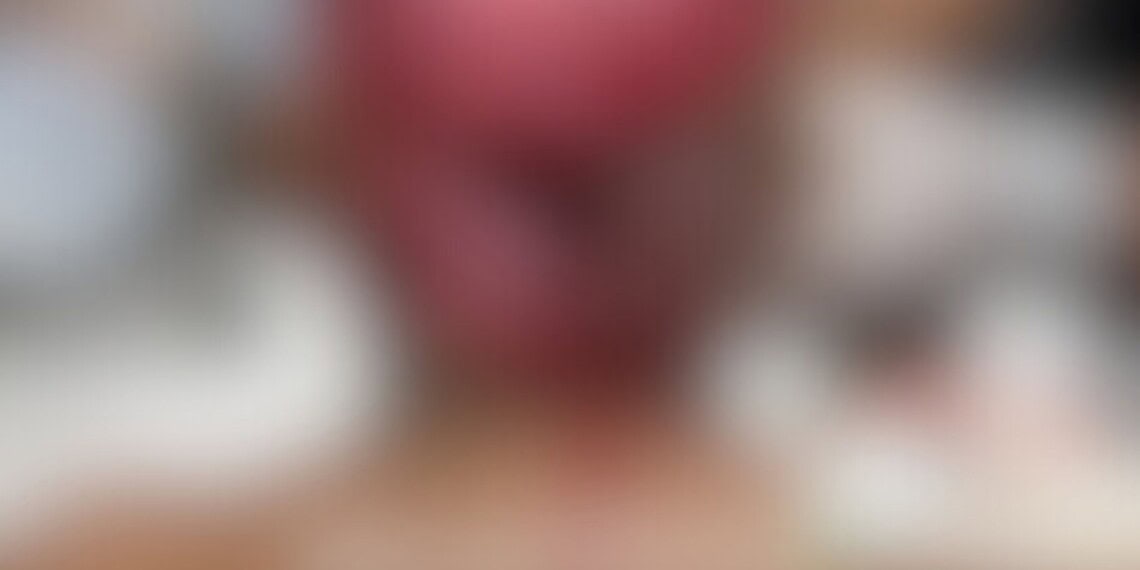 Jovem indígena sofre escalpelamento enquanto operava draga no Rio Acre, em Assis Brasil