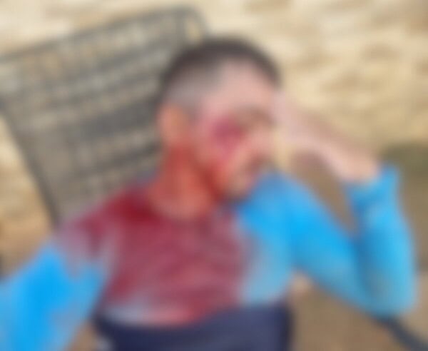 Gari é agredido após se recusar a recolher vidro descartado de forma irregular em Rio Branco