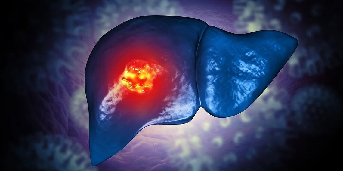 Câncer de fígado: mudança de hábitos pode prevenir até 60% dos casos 1 Mohammed Haneefa Nizamudeen/ Getty Images