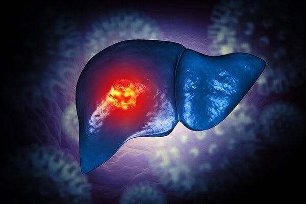Câncer de fígado: mudança de hábitos pode prevenir até 60% dos casos
