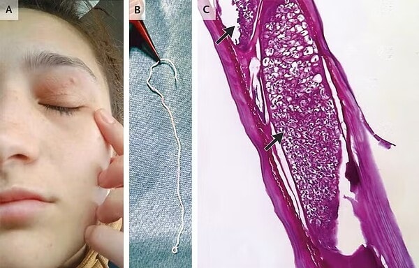 Mulher tem verme vivo de 11 cm retirado do olho