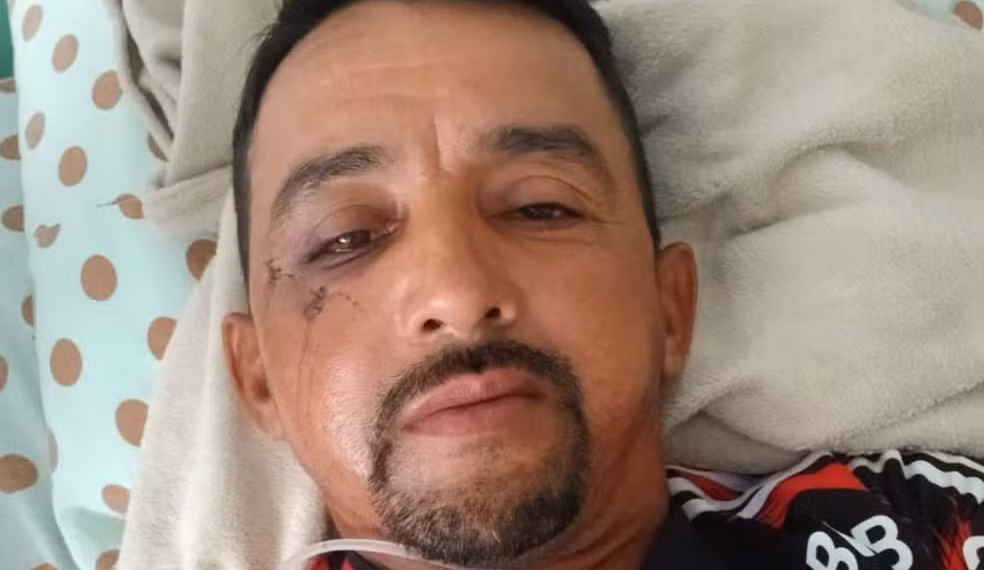 Gari agredido após se recusar a recolher vidro fará cirurgia para reconstruir o rosto 1 Foto: Arquivo Pessoal