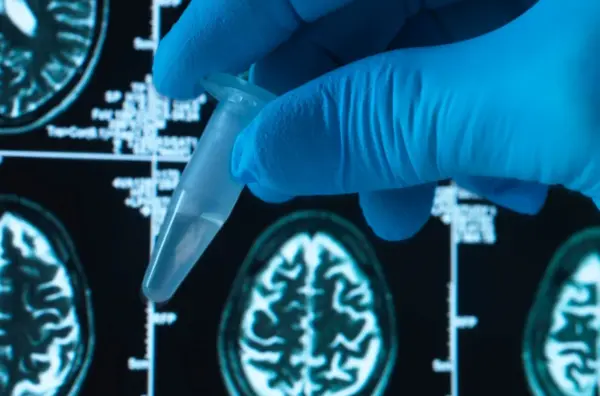 Brasileiros testam potencial remédio de baixo custo contra Alzheimer