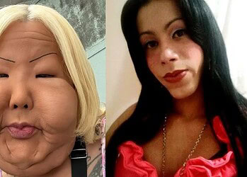 Influenciadora do RS passa por cirurgia reparadora para retirar óleo mineral do rosto 2 Foto: Reprodução