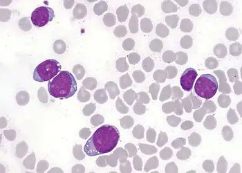 Células linfoblásticas T da leucemia aguda na medula óssea: poucas opções quando o tratamento principal falha - (crédito: WikimediaCommons/Divulgação )