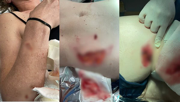 Mulher é mordida por capivara e tem partes do corpo arrancadas