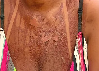 Vida mostra queimaduras causadas por bronzeamento artificial com fita — Foto: TV Globo