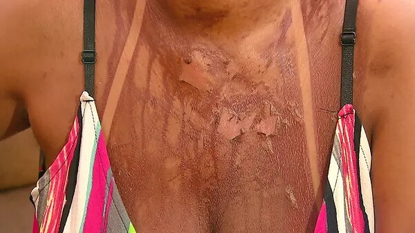 Estudo inédito mostra como bronzeamento artificial danifica o DNA da pele e favorece câncer agressivo