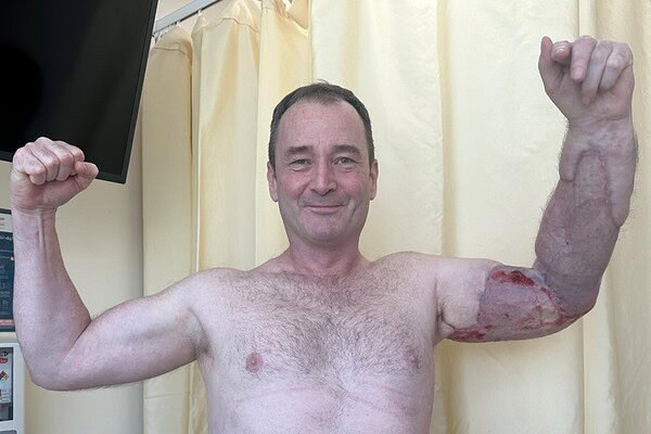 Homem quase perde o braço por bactéria após se machucar na academia