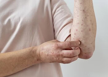 ‘Quase morri e não emagreci’: pacientes relatam reações graves após usar canetas emagrecedoras falsificadas 2 Ivete teve alergia similar a manchas causadas por sarampo devido ao uso de tirzepatida falsificada — Foto: Freepik