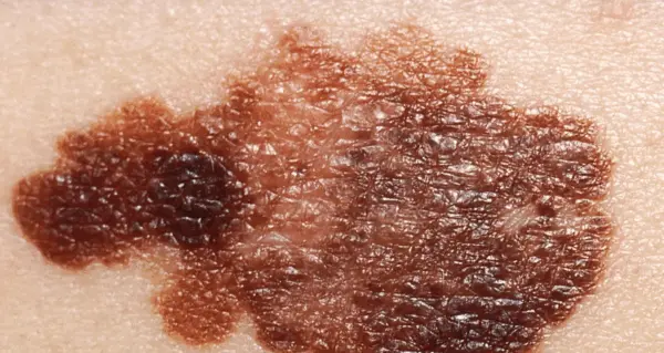 Câncer de pele: dermatologista diz como identificar sinais suspeitos