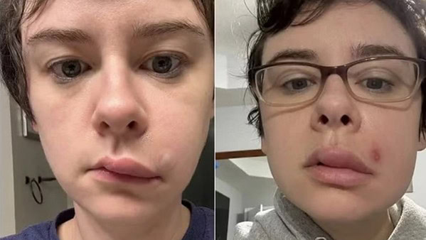 Jovem para no hospital após espremer espinha no “triângulo da morte”