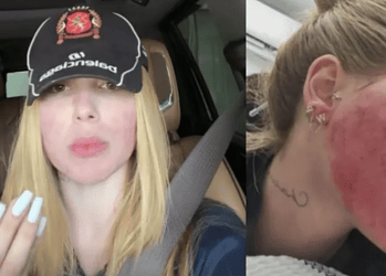 Virginia se arrepende de procedimento no rosto: "Tinha necessidade?" 2 Foto: Virginia Fonseca se questiona sobre procedimento que fez • Instagram/Virginia Fonseca