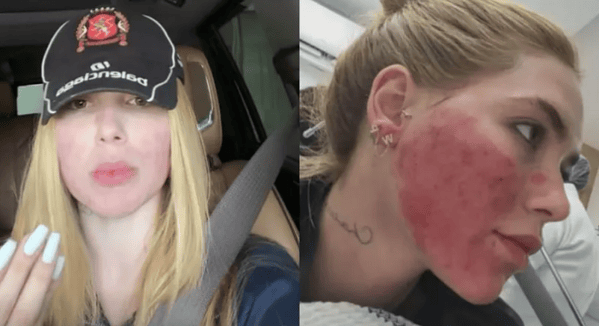 Virginia se arrepende de procedimento no rosto: "Tinha necessidade?"