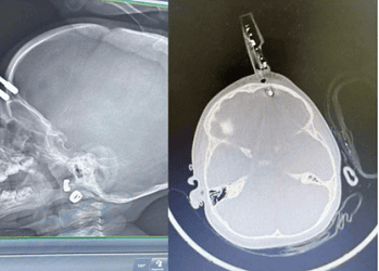 Carregador fica preso no crânio de bebê - (crédito: Cedido ao Correio)