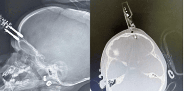 Carregador fica preso no crânio de bebê - (crédito: Cedido ao Correio)