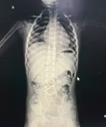 O procedimento de retirada deverá acontecer ainda na tarde desta sexta-feira. Foto: Cedida