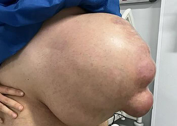 Com hérnia abdominal, homem fica com barriga enorme: “Cresceu em 1 mês”