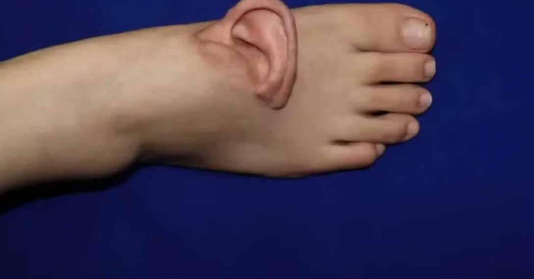 Médicos enxertaram orelha em pé de paciente na China — Foto: Divulgação/Shandong Provincial Hospital