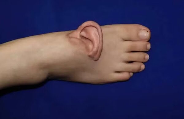 Médicos enxertam orelha em pé de paciente