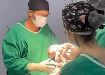 “Complexo”, diz médico sobre siameses com 3 pernas que nasceram em GO 2 Foto: Divulgação/Hemu