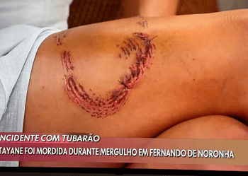 Tayane afirmou que o ferimento tem boa cicatrização — Foto: Reprodução/TV Globo