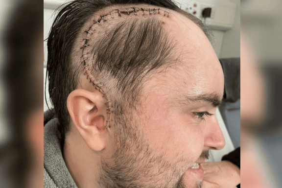 Homem ignora sinais de tumor no cérebro achando ser dor de musculação.