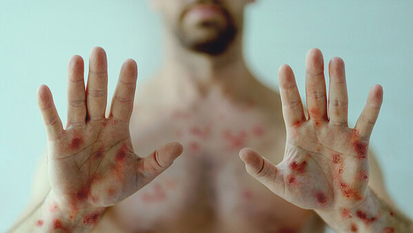 Casos de Mpox em Rondônia colocam Acre em alerta e Saúde reforça monitoramento na fronteira