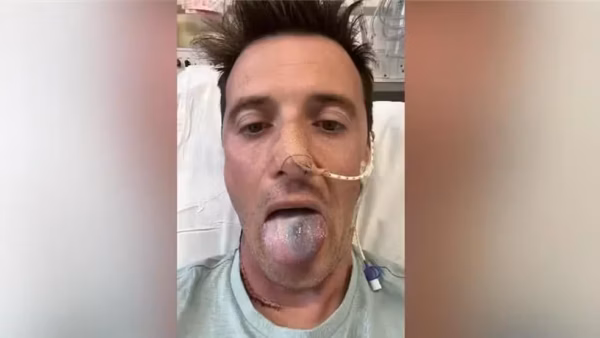 'Quase perdi a língua por um câncer e agora alerto outros homens sobre o risco do HPV'