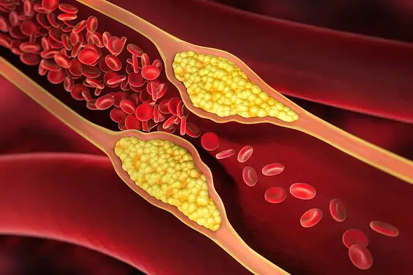 Médico aponta exercícios que ajudam a reduzir a gordura nas artérias