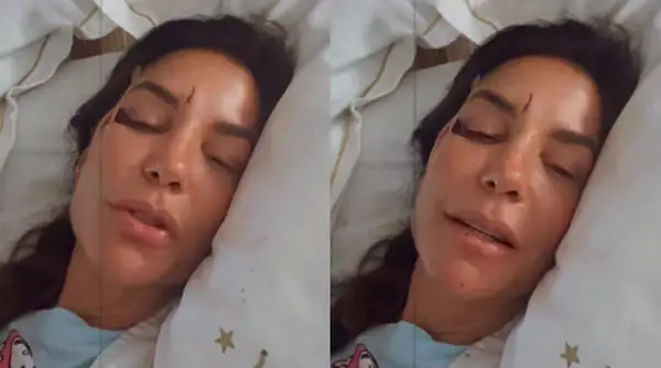 Ivete Sangalo aparece com rosto machucado e tranquiliza fãs após queda