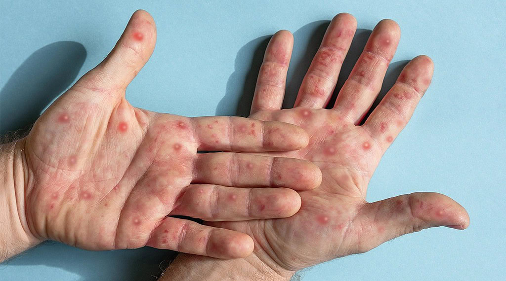 A prefeitura segue monitorando o caso. Foto: Reprodução/Internet