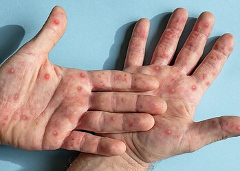 A prefeitura segue monitorando o caso. Foto: Reprodução/Internet