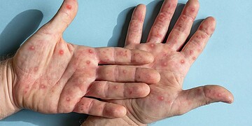 A prefeitura segue monitorando o caso. Foto: Reprodução/Internet