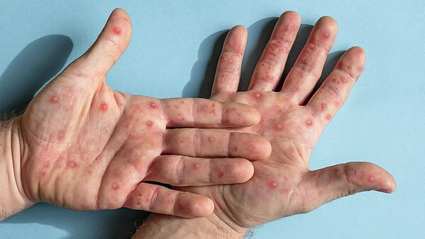 Saúde divulga novos detalhes sobre caso suspeito de Mpox em Rio Branco