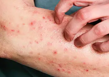 URGENTE: Rio Branco registra um caso suspeito de Mpox