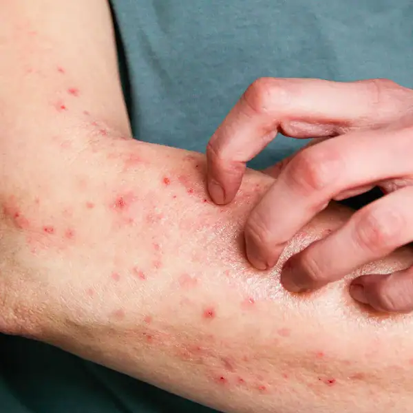 URGENTE: Rio Branco registra um caso suspeito de Mpox