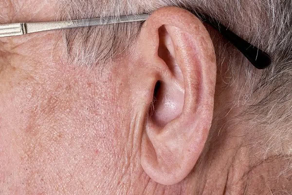 Sinal de Frank: dobra na orelha pode indicar risco cardíaco?