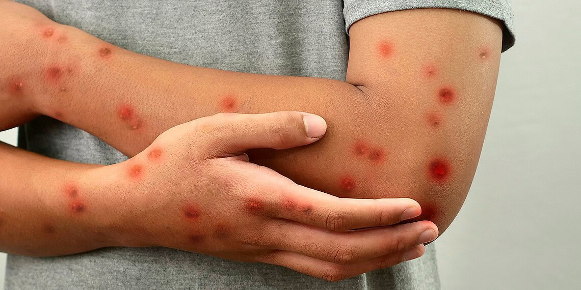 Acre segue sem casos de Mpox registrados em 2026; Sesacre adota medidas de prevenção
