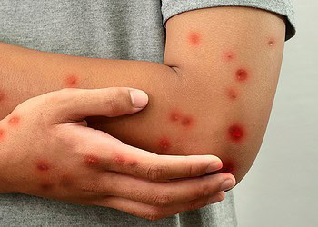 Acre segue sem casos de Mpox registrados em 2026; Sesacre adota medidas de prevenção 3 Acre segue sem casos de Mpox registrados em 2026; Sesacre adota medidas de prevenção