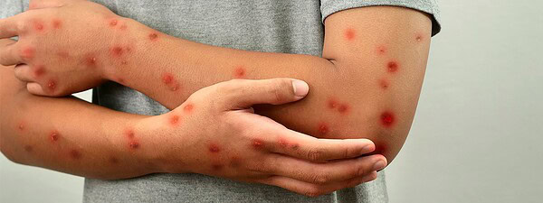 Acre segue sem casos de Mpox registrados em 2026; Sesacre adota medidas de prevenção