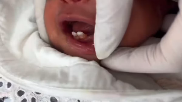 VÍDEO: bebê nasce com dois dentes e passa por cirurgia aos 6 dias de vida