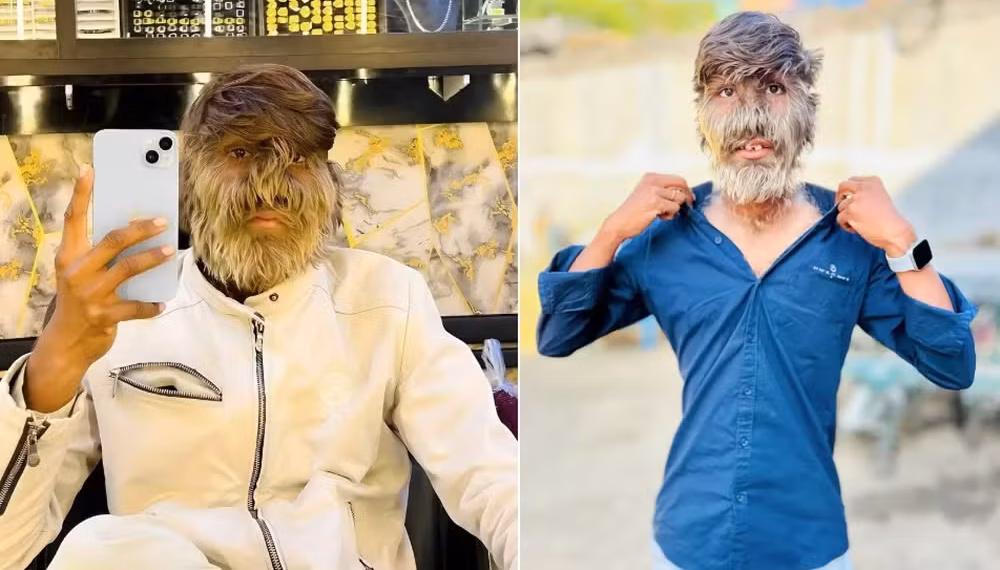 'Síndrome de lobisomem': jovem com o rosto mais peludo do mundo vira influencer e revela as dificuldades do dia a dia