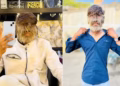 'Síndrome de lobisomem': jovem com o rosto mais peludo do mundo vira influencer e revela as dificuldades do dia a dia