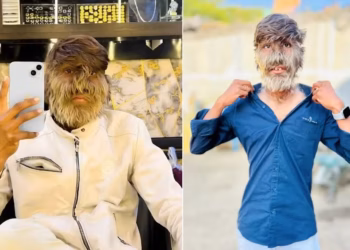 'Síndrome de lobisomem': jovem com o rosto mais peludo do mundo vira influencer e revela as dificuldades do dia a dia