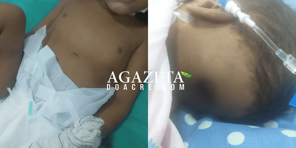 Mãe denuncia falta de material para curativos em criança que teve pé amputado em hospital de Rio Branco